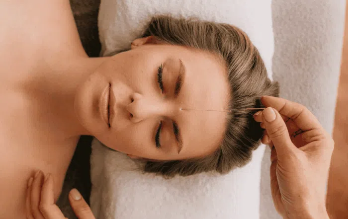 woman with acupuncture needles on forehead