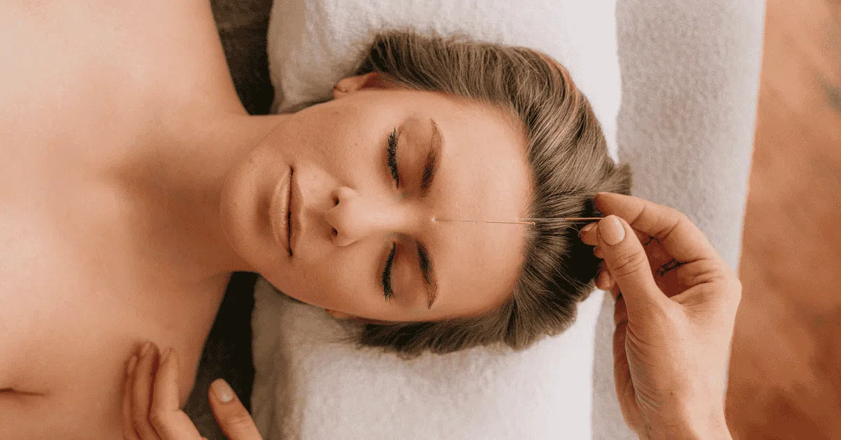 woman with acupuncture needles on forehead