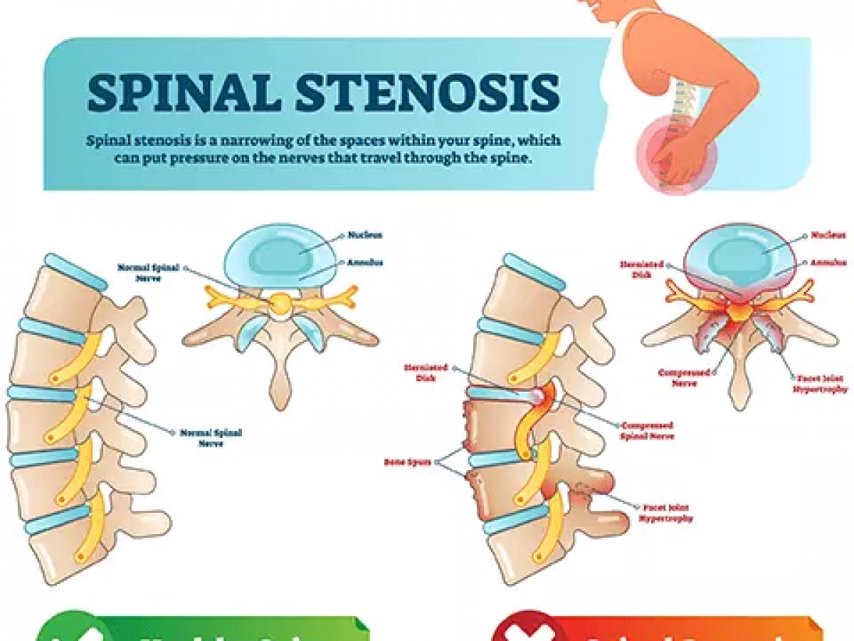 All About Spinal Stenosis & What You Can Do About It! — More Life Health -  Seniors Health & Fitness